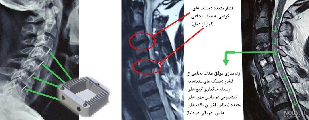 تفسیر عکس ام ار ای ستون فقرات تفسیر عکس ام ار ای ستون فقرات