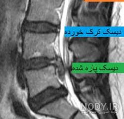 عکس ام ار ای دیسک کمر سالم عکس ام ار ای دیسک کمر سالم