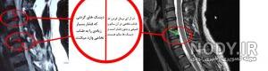 عکس ام ار ای دیسک گردن عکس ام ار ای دیسک گردن