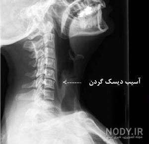 عکس ام ار ای دیسک گردن سالم عکس ام ار ای دیسک گردن سالم