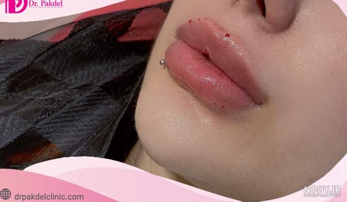 عکس لب ژل زده عکس لب ژل زده