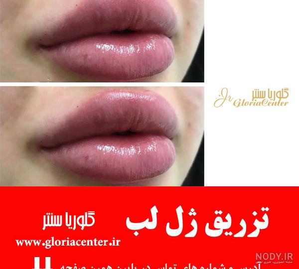 عکس ژل لب عروسکی عکس ژل لب عروسکی