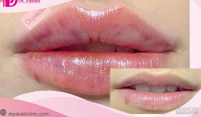 عکس ژل لب قبل و بعد عکس ژل لب قبل و بعد
