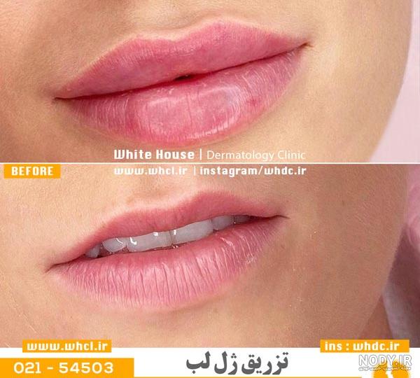 عکس ژل لب مدل روسی عکس ژل لب مدل روسی
