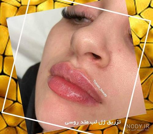قیمت تزریق ژل لب در گرگان قیمت تزریق ژل لب در گرگان