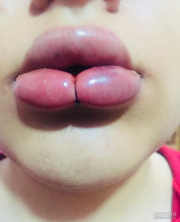 قیمت تزریق ژل لب در یزد قیمت تزریق ژل لب در یزد