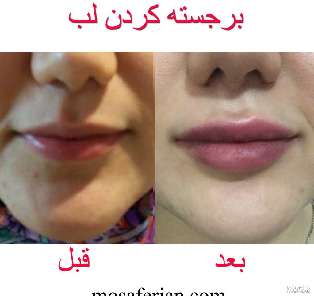 قیمت هر سی سی ژل لب قیمت هر سی سی ژل لب