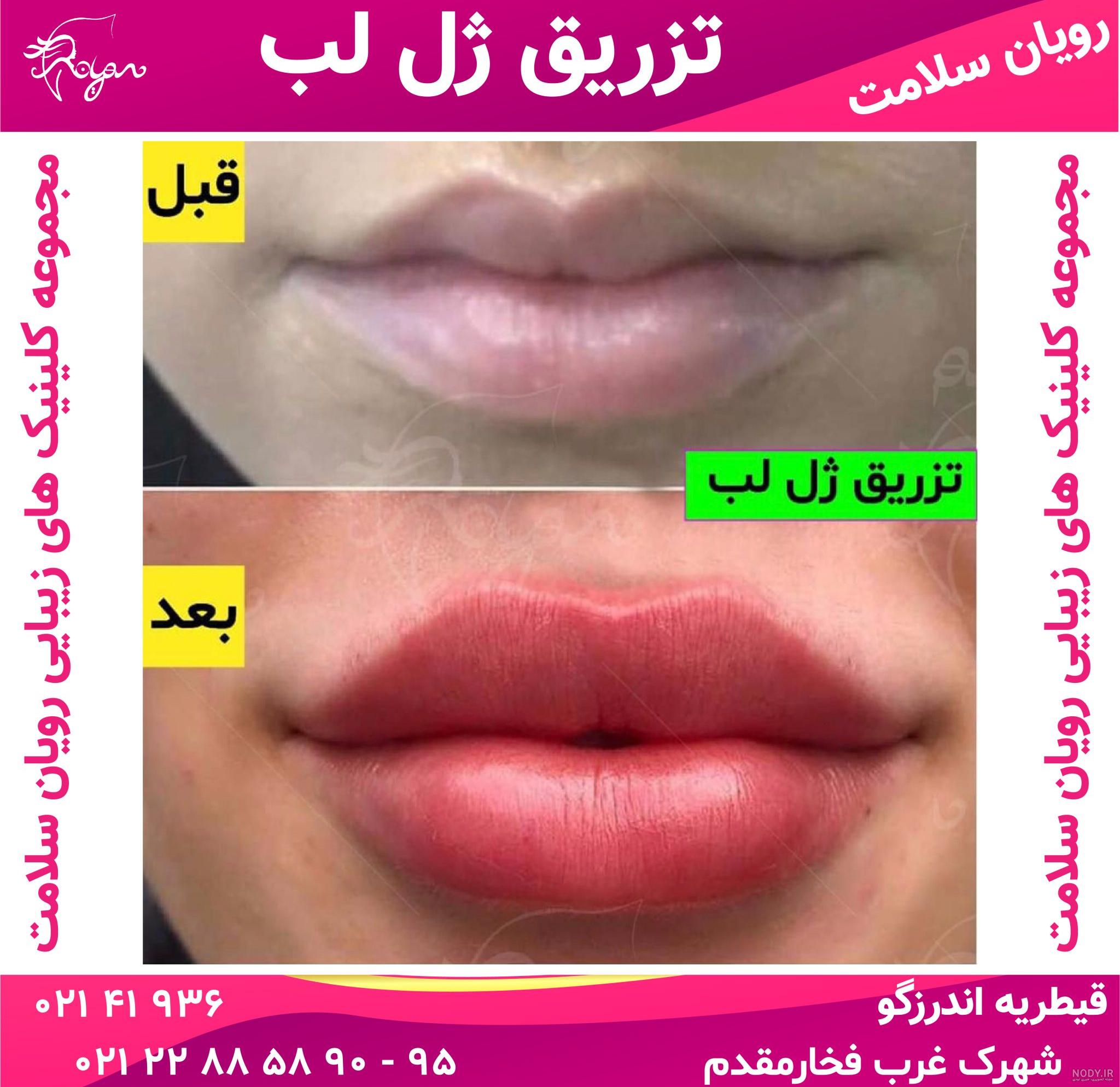 ژل لب مدل سه دکمه ای ژل لب مدل سه دکمه ای