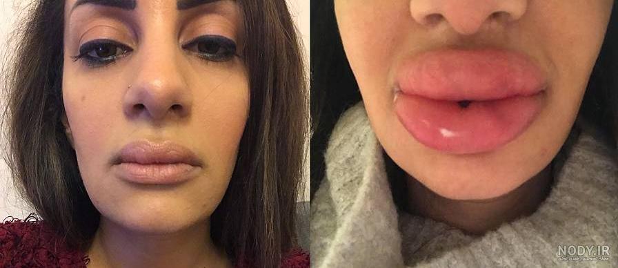 تزریق ژل لب مدل باربی تزریق ژل لب مدل باربی