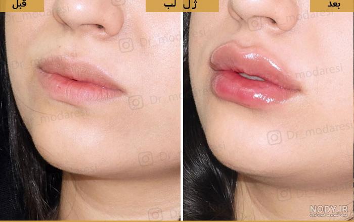 تزریق ژل لب مدل روسی تزریق ژل لب مدل روسی