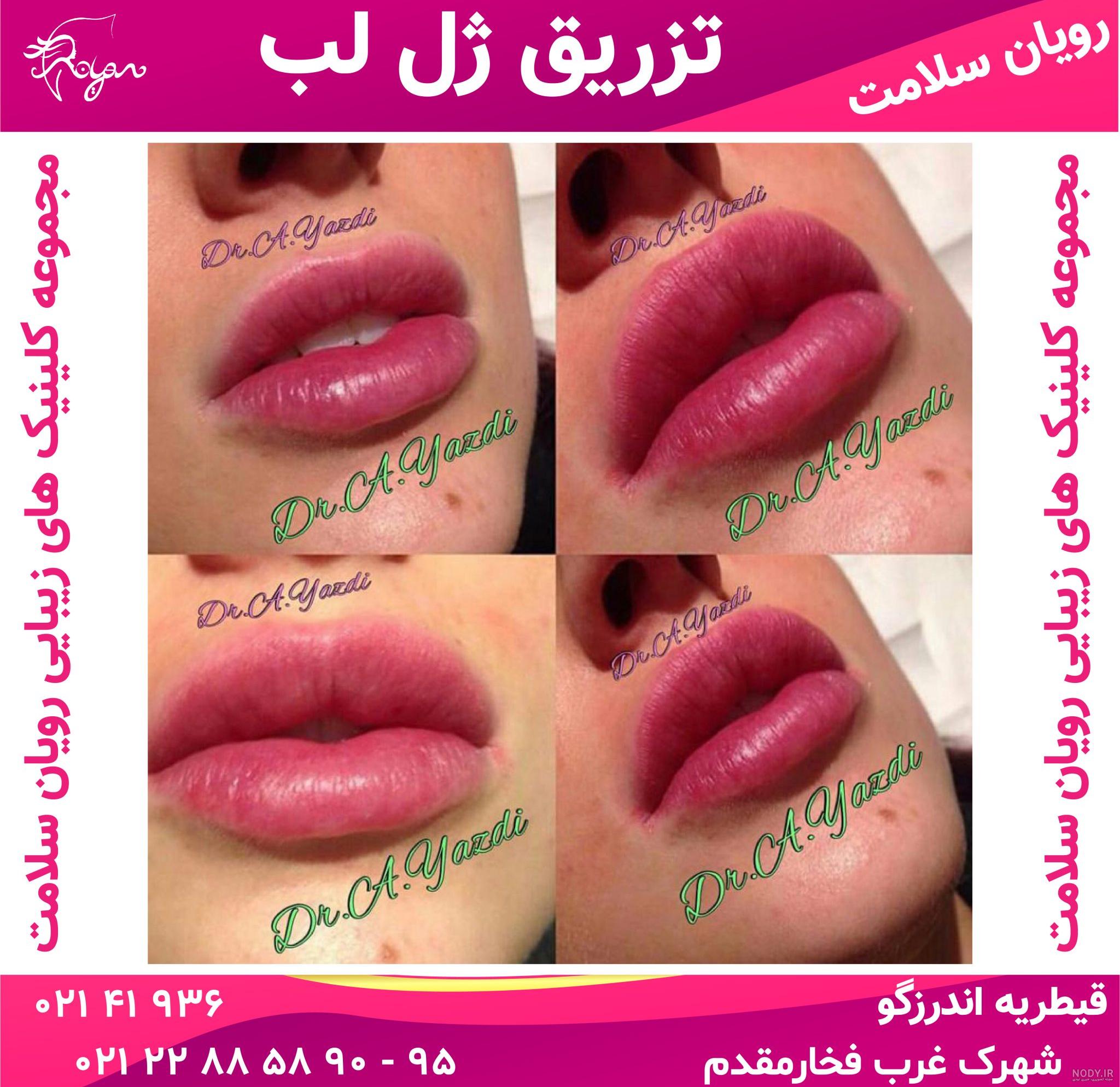 تزریق ژل لب مدل طبیعی تزریق ژل لب مدل طبیعی