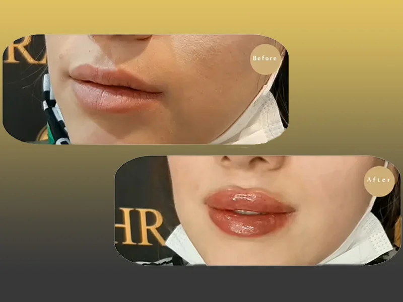 تزریق ژل لب مدل عروسکی تزریق ژل لب مدل عروسکی