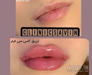 تزریق ژل لب مدل نچرال تزریق ژل لب مدل نچرال