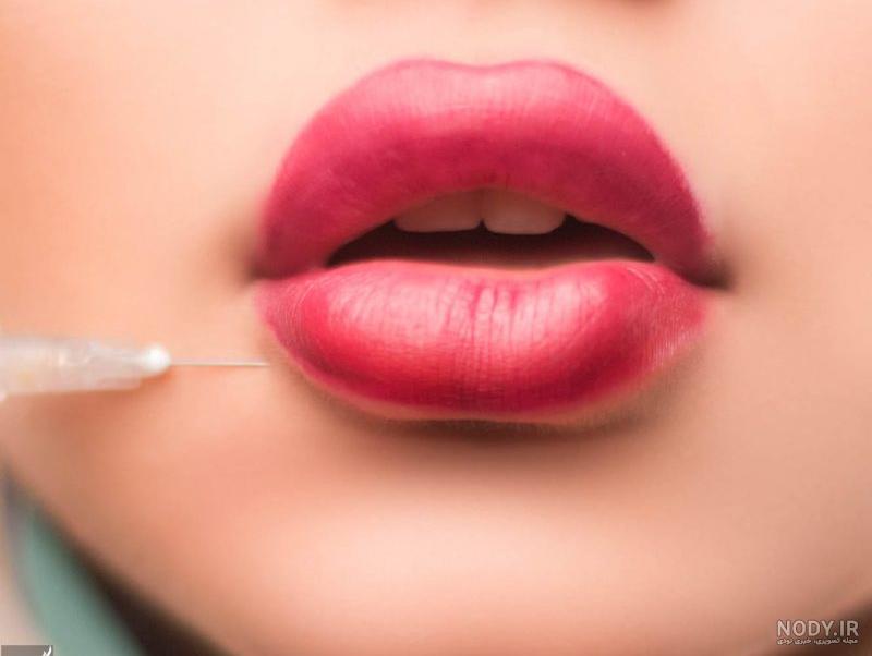 تزریق ژل لب مدل هالیوودی تزریق ژل لب مدل هالیوودی