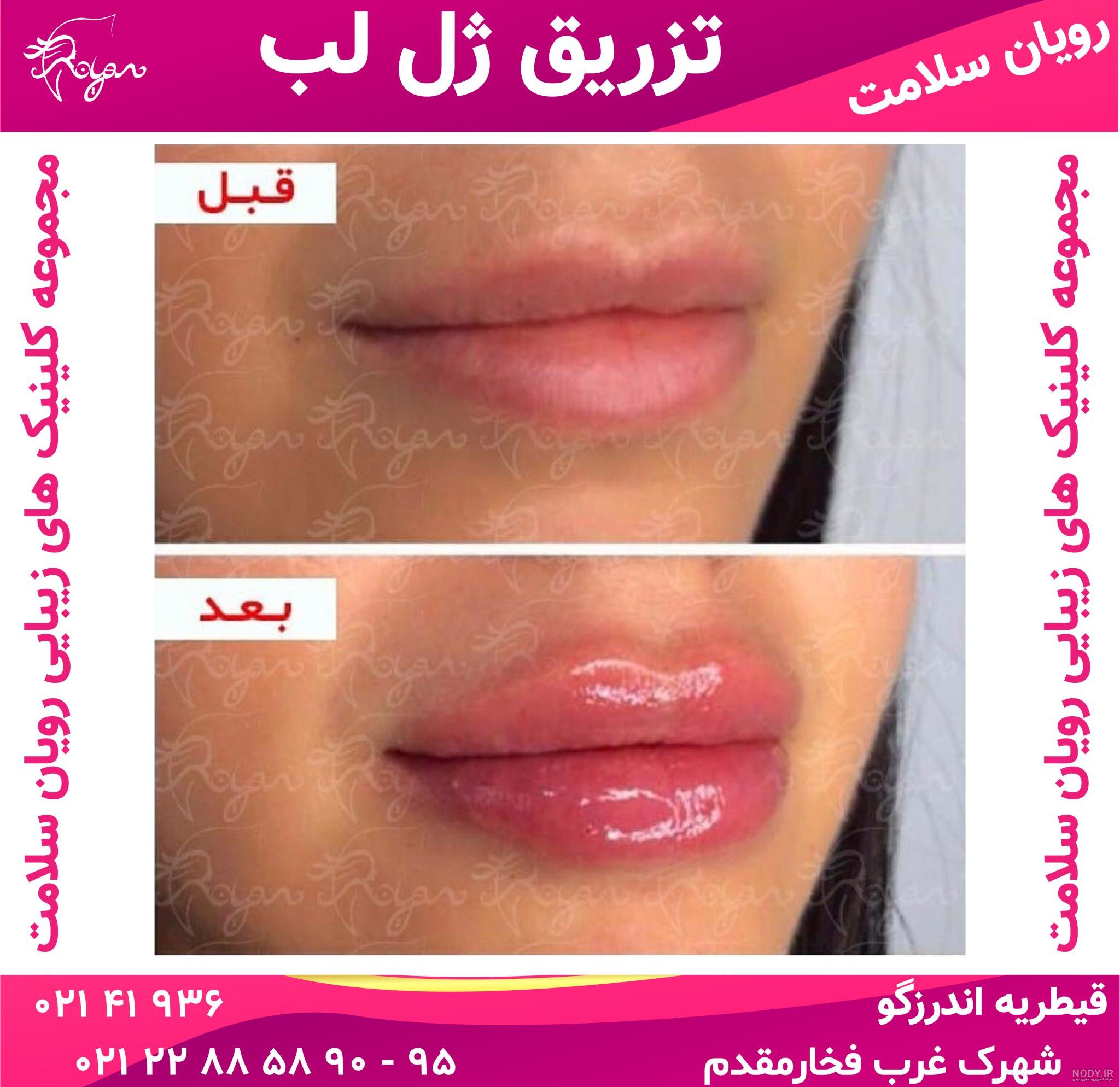 تزریق ژل لب مدل چاک دار تزریق ژل لب مدل چاک دار
