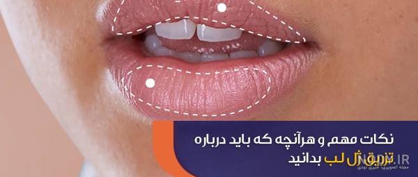 تزریق ژل لب مدل گرد تزریق ژل لب مدل گرد