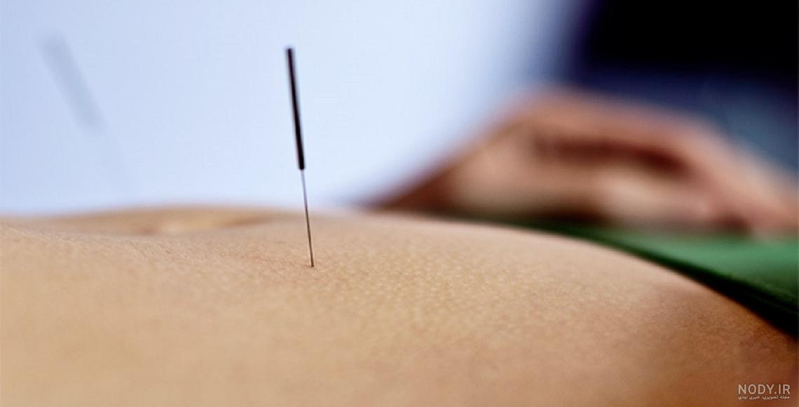 جدیدترین روش تخلیه چربی شکم جدیدترین روش تخلیه چربی شکم