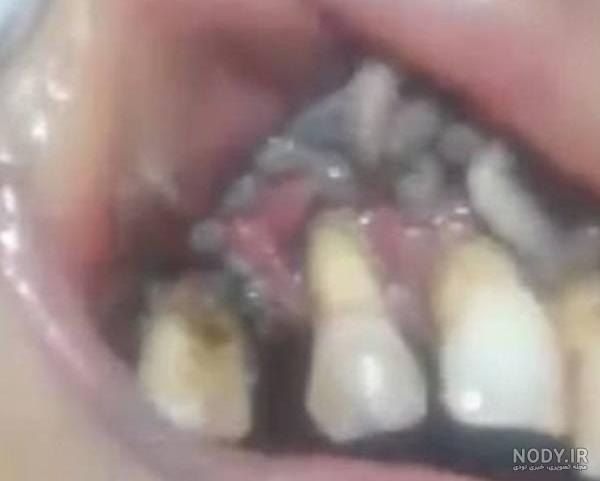 دندان پوسیده را چه باید کرد دندان پوسیده را چه باید کرد