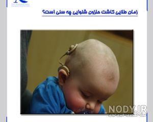 معایب کاشت حلزون معایب کاشت حلزون