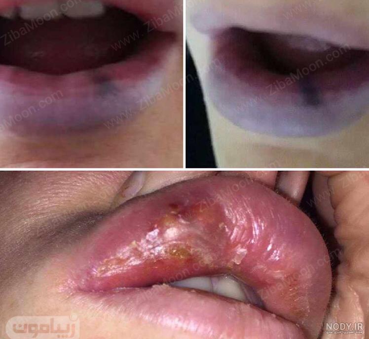 مقدار یک سی سی ژل لب چقدر است مقدار یک سی سی ژل لب چقدر است