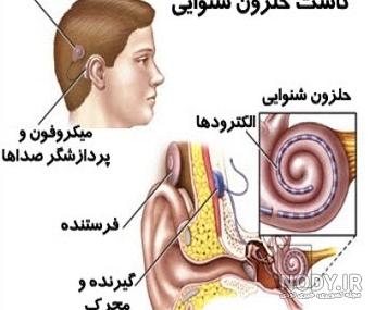 هزینه کاشت حلزون گوش کودکان هزینه کاشت حلزون گوش کودکان