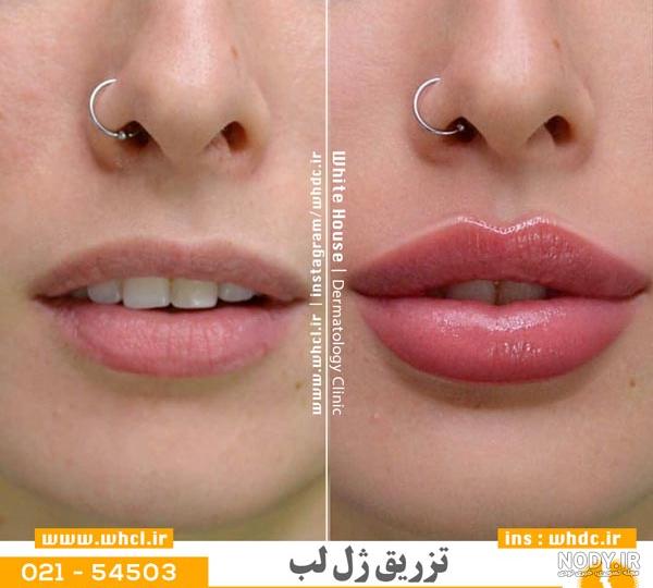 آموزش تزریق ژل لب مدل روسی آموزش تزریق ژل لب مدل روسی