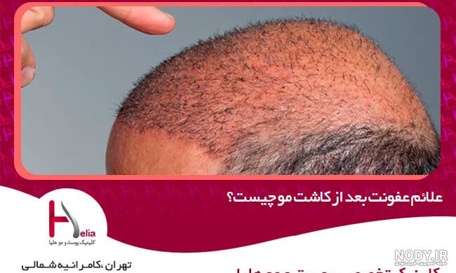 بهترین فصل کاشت مو بهترین فصل کاشت مو