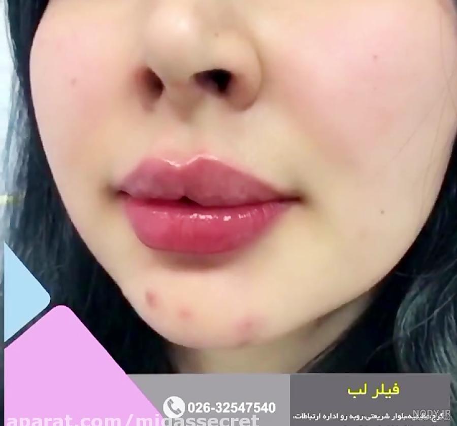 تزریق ژل لب مدل روسی تزریق ژل لب مدل روسی