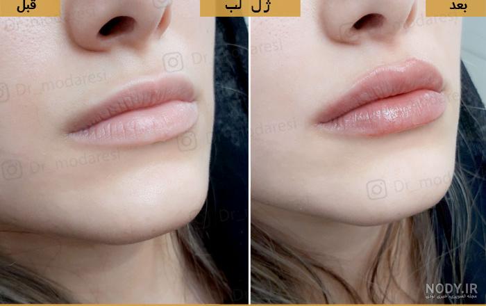 تزریق ژل لب مدل عروسکی تزریق ژل لب مدل عروسکی