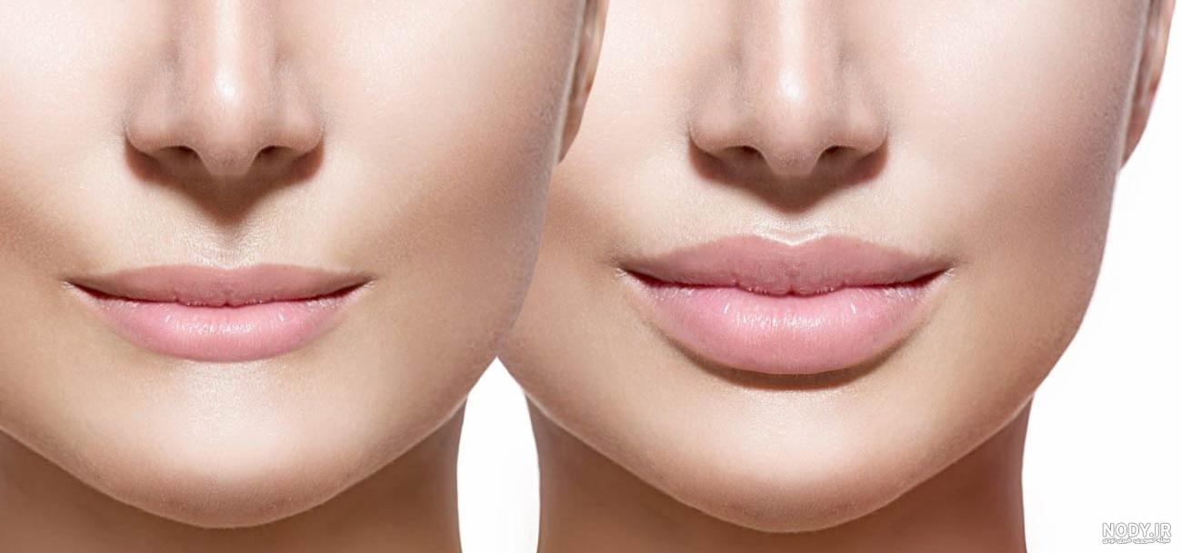 تزریق ژل لب مدل فانتزی تزریق ژل لب مدل فانتزی