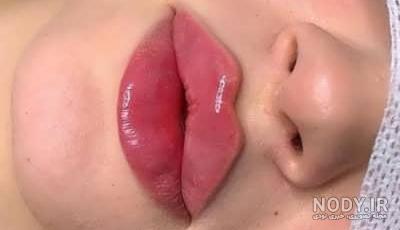 تزریق ژل لب مدل فانتزی تزریق ژل لب مدل فانتزی