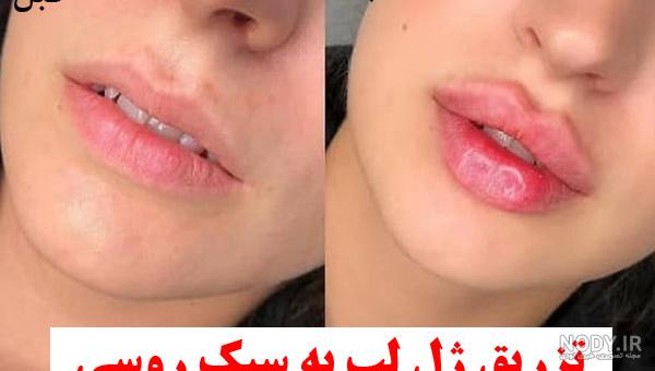تزریق ژل لب مدل قلوه ای تزریق ژل لب مدل قلوه ای