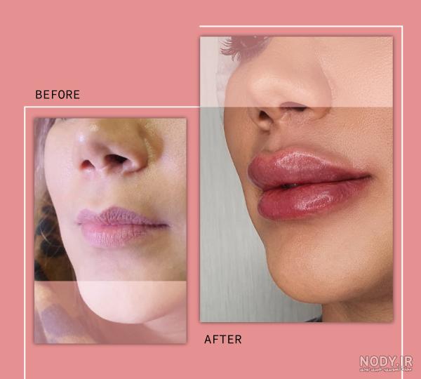 تزریق ژل لب مدل نچرال تزریق ژل لب مدل نچرال