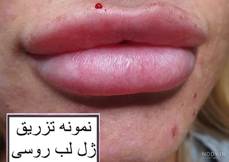 تزریق ژل لب مدل چاک دار تزریق ژل لب مدل چاک دار