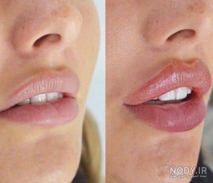 تزریق ژل لب مدل گرد تزریق ژل لب مدل گرد