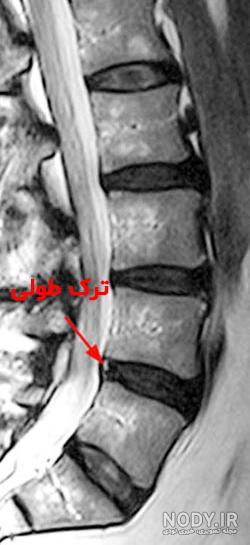 تعداد مهره های کمر