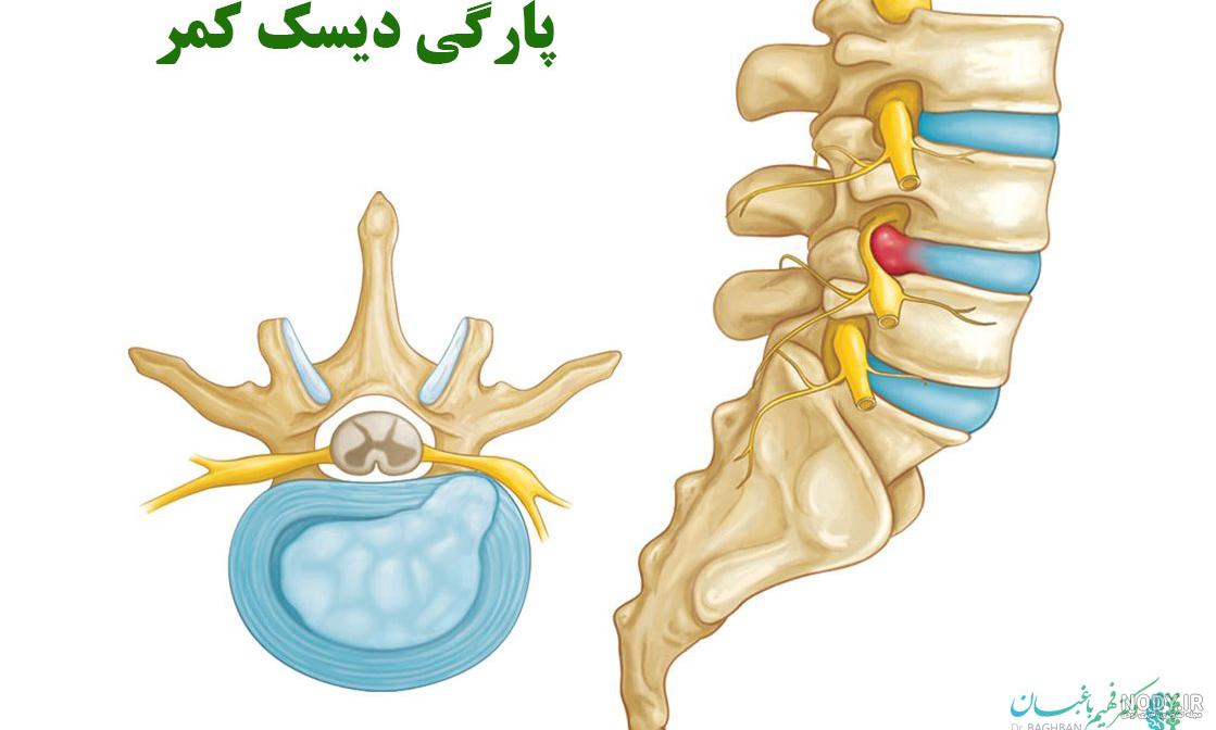 تفسیر عکس رادیولوژی کمر