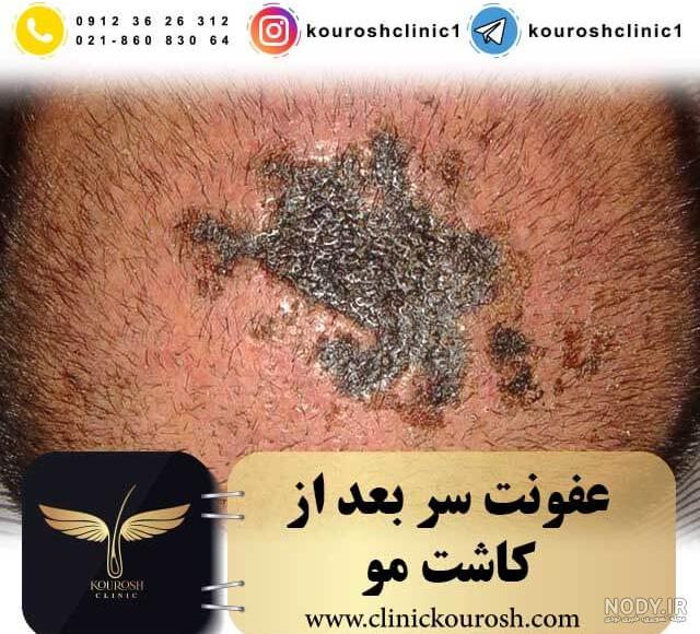 روغن زیتون بعد از کاشت مو روغن زیتون بعد از کاشت مو