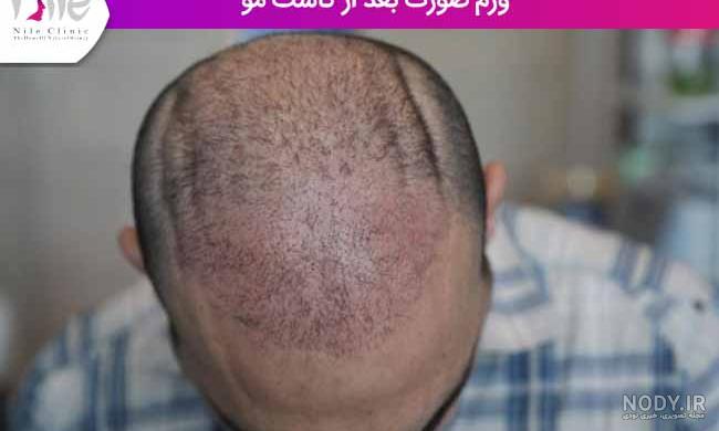 عوارض کاشت مو به روش fut عوارض کاشت مو به روش fut
