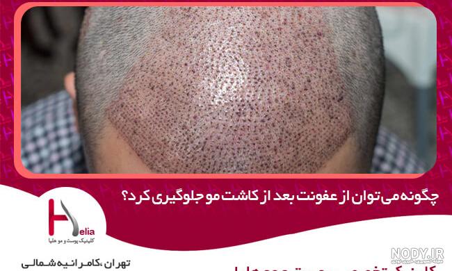 عوارض کاشت مو نی نی سایت عوارض کاشت مو نی نی سایت