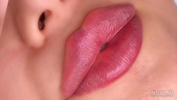 عکس تزریق ژل لب مدل روسی عکس تزریق ژل لب مدل روسی