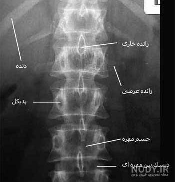 عکس رادیولوژی اسکولیوز