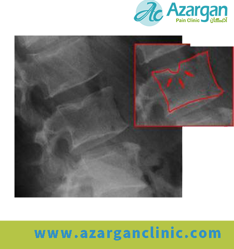 عکس رادیولوژی دنبالچه سالم