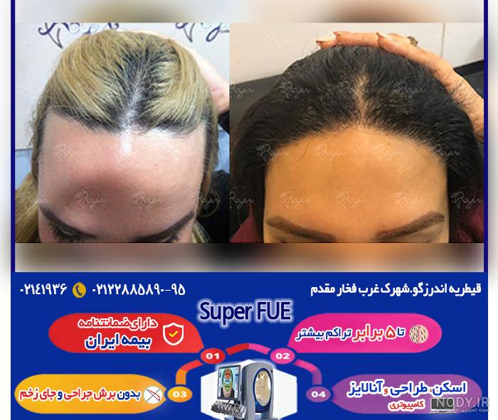 عکس های قبل و بعد از کاشت مو عکس های قبل و بعد از کاشت مو