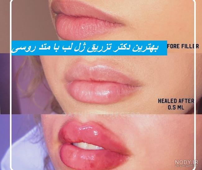 عکس ژل لب مدل روسی عکس ژل لب مدل روسی