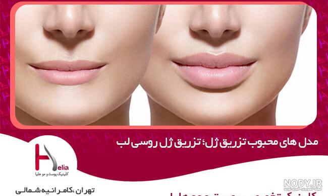 عکس ژل لب مدل عروسکی عکس ژل لب مدل عروسکی