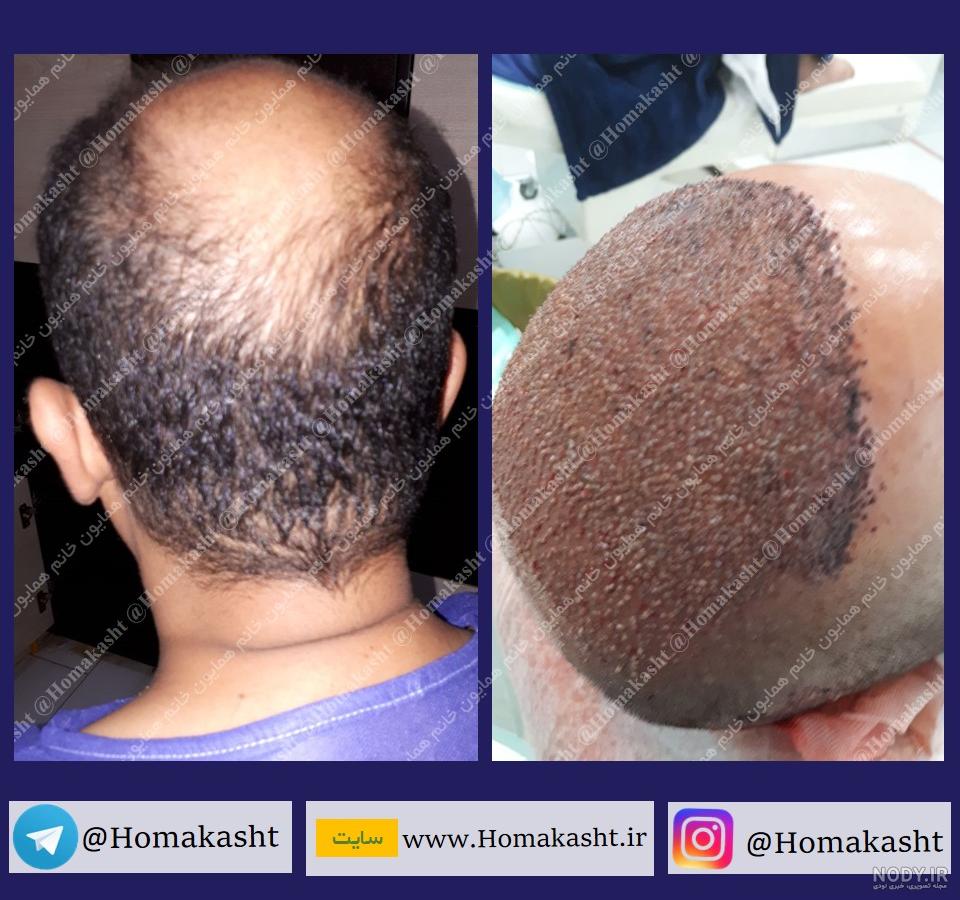 عکس کاشت ابرو بعد از چند ماه عکس کاشت ابرو بعد از چند ماه