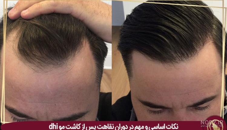 عکس کاشت مو بعد از سه ماه عکس کاشت مو بعد از سه ماه