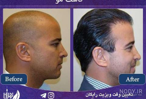 عکس کاشت مو بعد از پنج ماه عکس کاشت مو بعد از پنج ماه