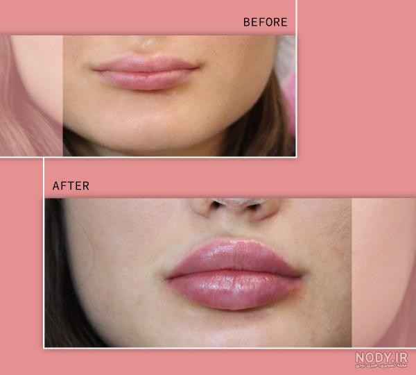 قیمت تزریق ژل لب مدل روسی قیمت تزریق ژل لب مدل روسی